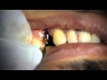 Permanent teeth in 3 days in India