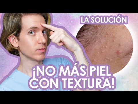 Como ELIMINAR los COMEDONES CERRADOS - Fácil y efectivo - Recomendaciones de un dermatologo