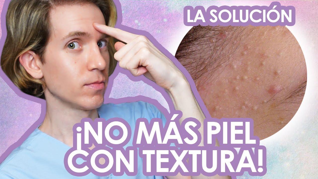 Como ELIMINAR los COMEDONES CERRADOS - Fácil y efectivo - Recomendaciones de un dermatologo