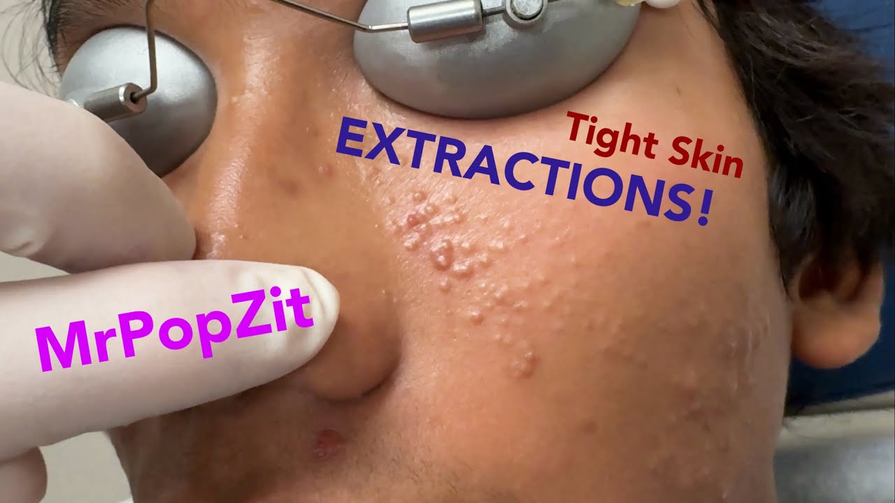 Tight skin acne extractions! Comedonal acne with some inflammatory