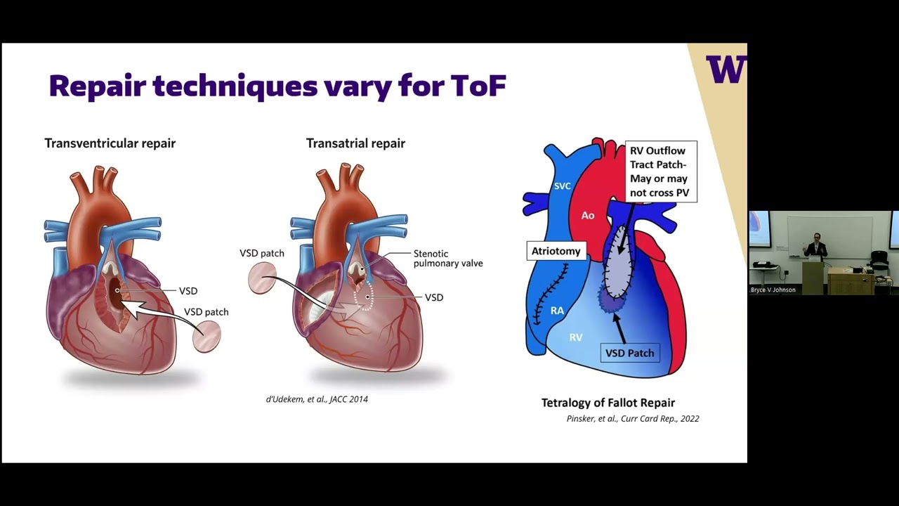 Tetralogy of Fallot