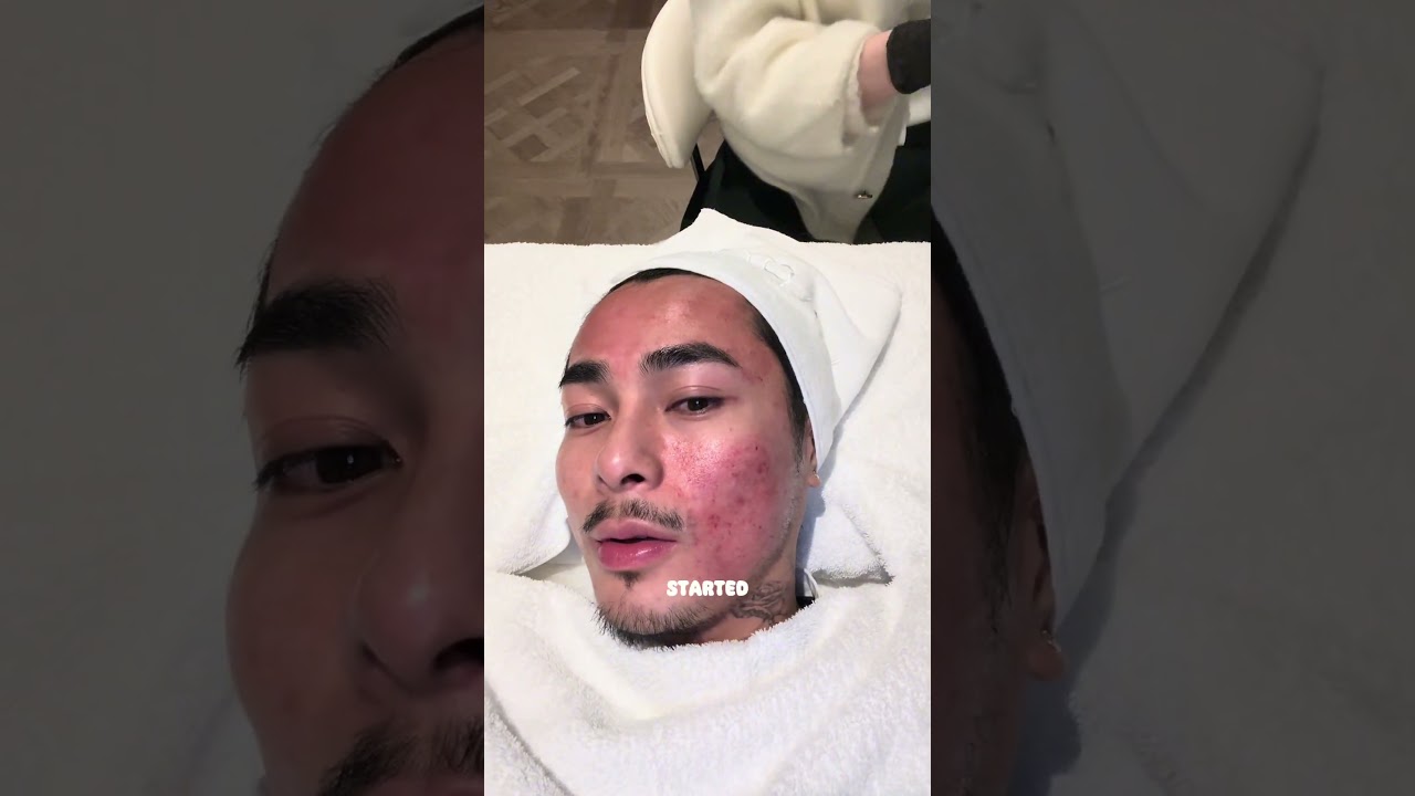 I recommend microneedling #london #skincare #acne #scars #microneedling