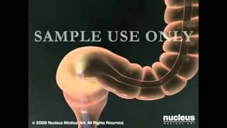 Colonoscopy Lower GI Endoscopy