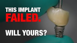 You're designing implants to FAIL and you don't even know it!