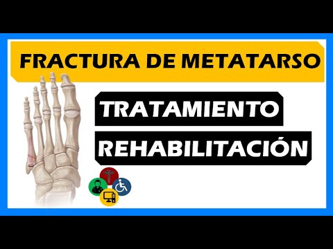 ¿Es necesario operar? FRACTURA DE METATARSO