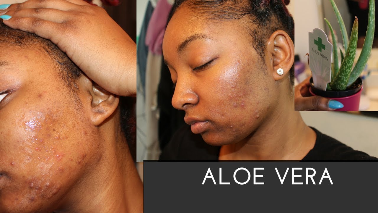 I Used Aloe Vera On My Face For 5 Days It Ruined My Face Must