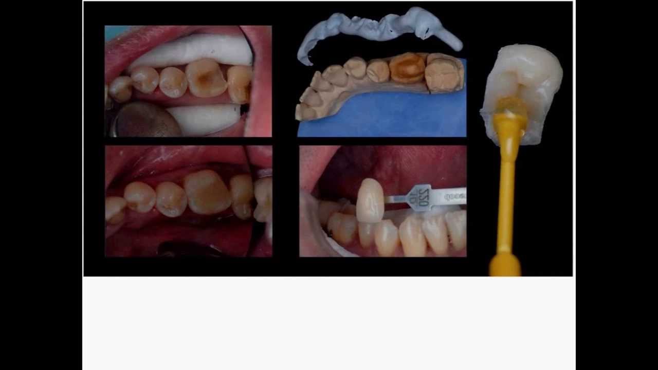 069 Principios básicos de adhesión para la odontología de mínima