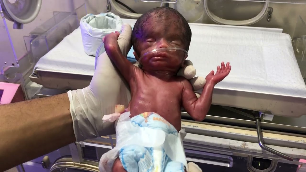 Critical Hydrocephalus Newborn in NICU | Step-by-Step Management & Safe Incubator Shifting Protocols