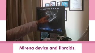 Mirena Device And Fibroids