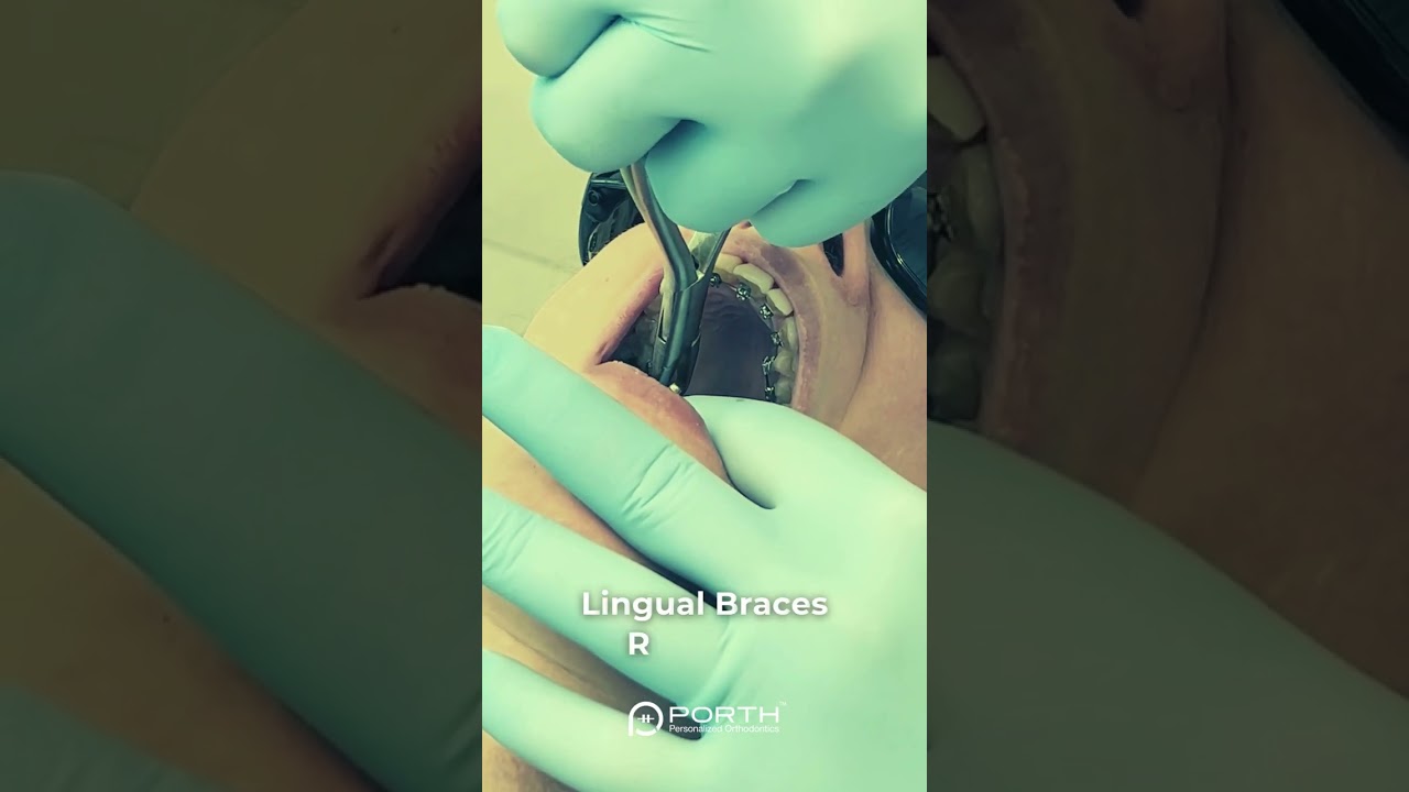 Lingual Braces Removal 😎