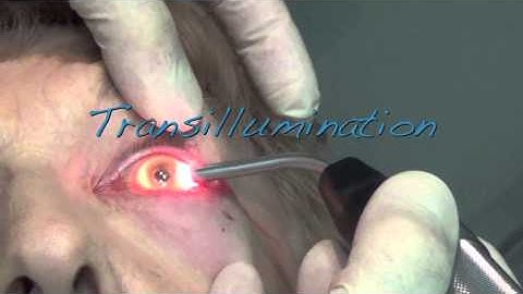 9728 TSCPC Transillumination