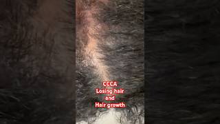 Central Centrifugal Cicatricial Alopecia Living With Ccca