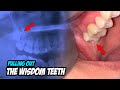It’s very challenging to remove wisdom teeth that are all embedded.