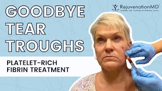 PlateletRich Fibrin Treatment for Tear Troughs