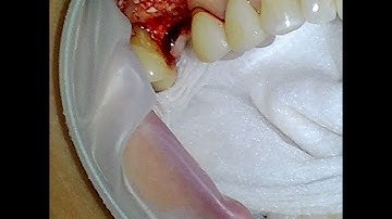 Lateral Sinus Lift with Implant Placement and L-PRF