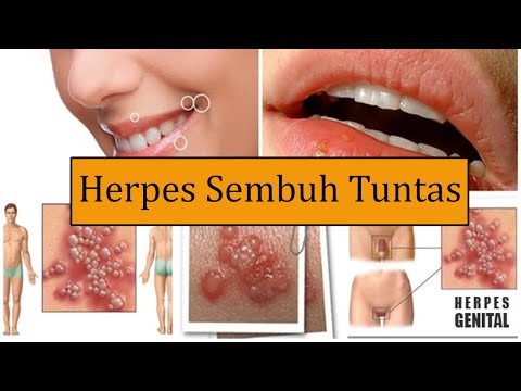 cara-mengobati-herpes-secara-alami-dan-cepat-||-obat-herpes-terbukti-ampuh