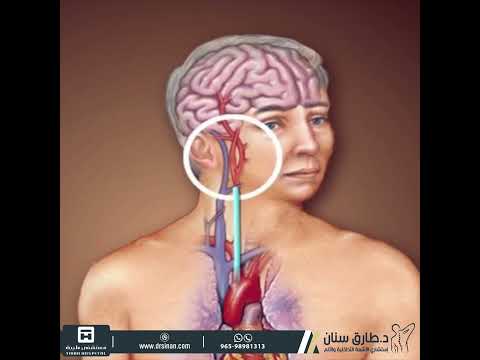 فيديو: هل دعامة الشريان السباتي آمنة؟