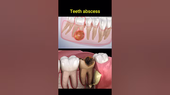 Tooth abscess problem #dentist #dentisty #teeth #dental