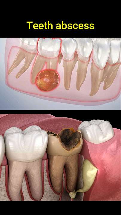 Tooth abscess problem #dentist #dentisty #teeth #dental