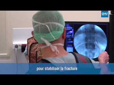 Vidéo: 4 façons de traiter les fractures de compression avec une chirurgie du dos