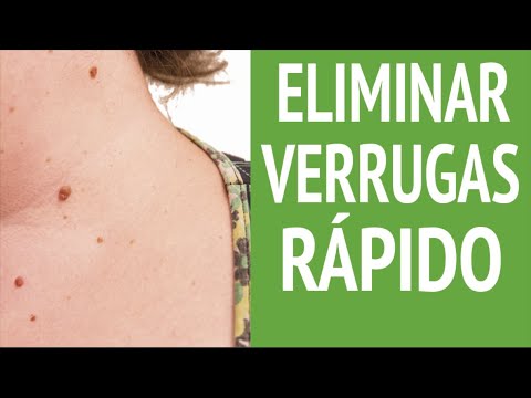 Cómo quitar las verrugas del cuello rápido: remedios caseros para eliminar las verrugas en el cuello @InnatiaTV