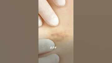 علامات تحذيرية قد تشير إلى حدوث جلطة بالدم 