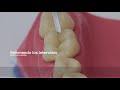 [ESP] Restauración de diente posterior con resina.