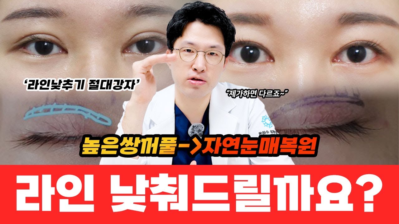 라인낮추기 눈재수술, 라인 낮추면 이렇게 달라집니다.