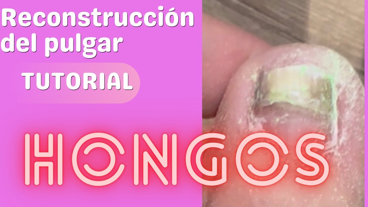 ¿Es doloroso el proceso de reconstrucción de uñas en los pies?