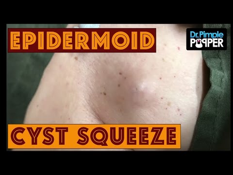 Don't Be Such A CYSTIE!! ????With Dr Pimple Popper