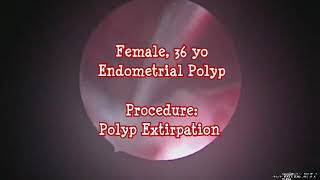 Polip endometrium salah penyebab kegagalan implantasi embrio (kegagalan program hamil)