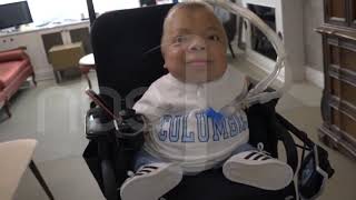 Alvarez life story , a 22 year old man who survived a severe skeletal disorder