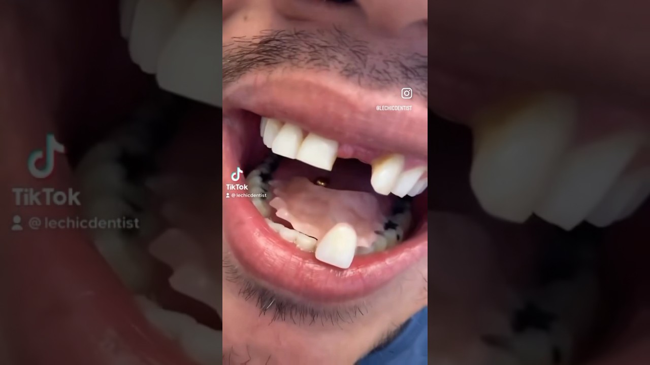 Missing the front tooth!!! 