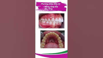 GẶP KHỚP CẮN SÂU - ĐỪNG ĐỂ LÂU - NHA KHOA NOVA