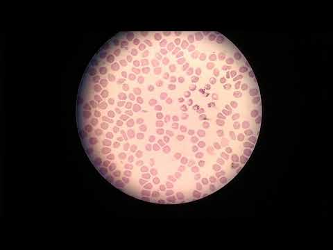 Video: Neutropenia (agranulositosis) - Penyebab, Gejala Dan Pengobatan Neutropenia