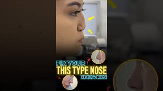 Fix Flat Nose Exercise