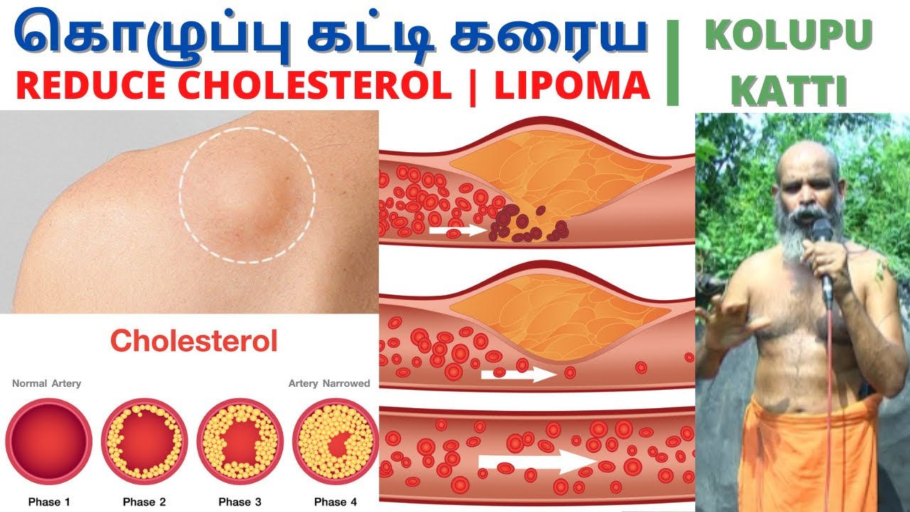 கொழுப்பு கட்டி கரைய | NATURAL REMEDIES FOR LIPOMA | kolupu katti | HOW TO  REDUCE CHOLESTEROL - YouTube
