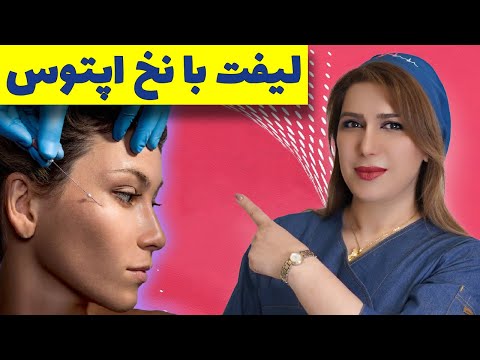 لیفت صورت با نخ چگونه است درمان افتادگی پوست صورت با نخ آپتوس چقدر ماندگاری دارد