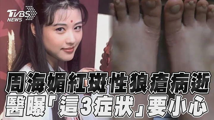 周海媚 病逝！医曝女性罹患 红斑性狼疮 机率高“3症状要小心”｜TVBS新闻　健康2.0 @tvbshealth20 - 天天要闻