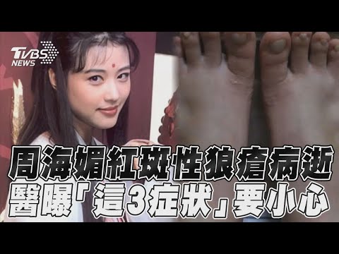 周海媚 病逝！醫曝女性罹患 紅斑性狼瘡 機率高「3症狀要小心」｜TVBS新聞 健康2.0 @tvbshealth20