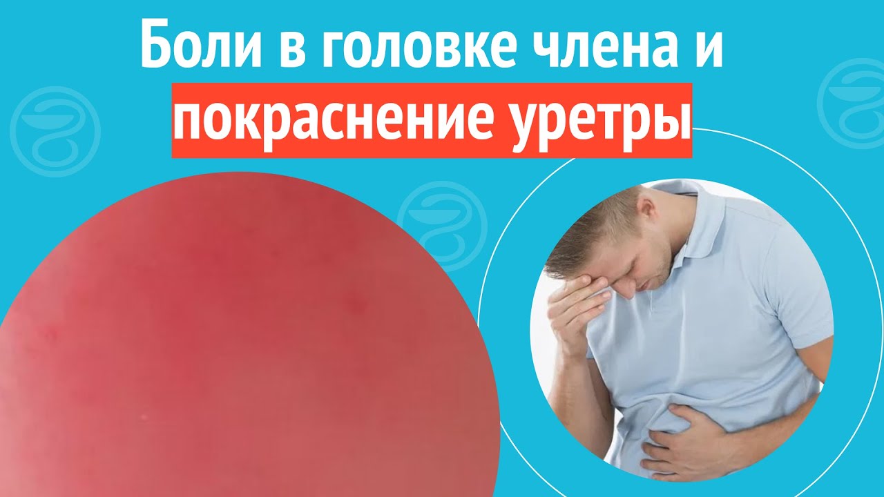 😓 Боли в головке члена и покраснение уретры. Клинический случай №1196 ...