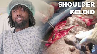 Shoulder Keloid - Dr. Michael Jones | Lexington Plastic Surgeons