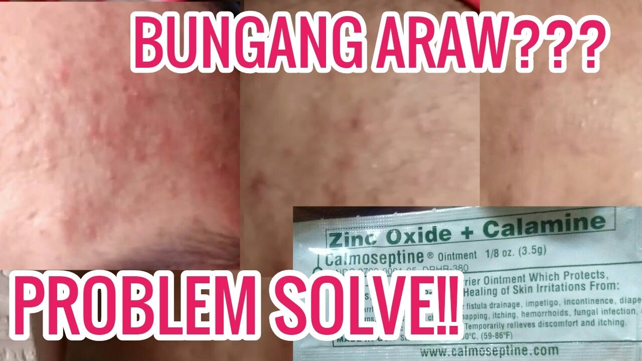 Effective Ointment para sa Bungang Araw Nawala in Just 3 Days