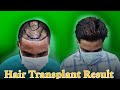 Fue hair transplant result  kolkata  dr jayanta bain plastic surgeon