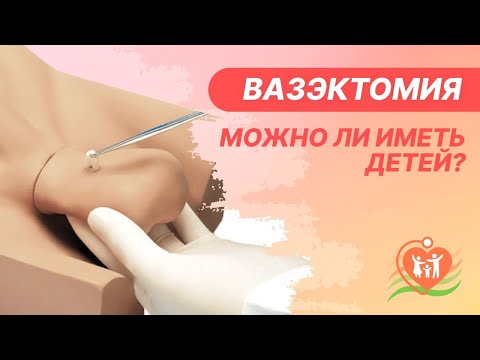 ➡ Вазэктомия - можно ли иметь детей?