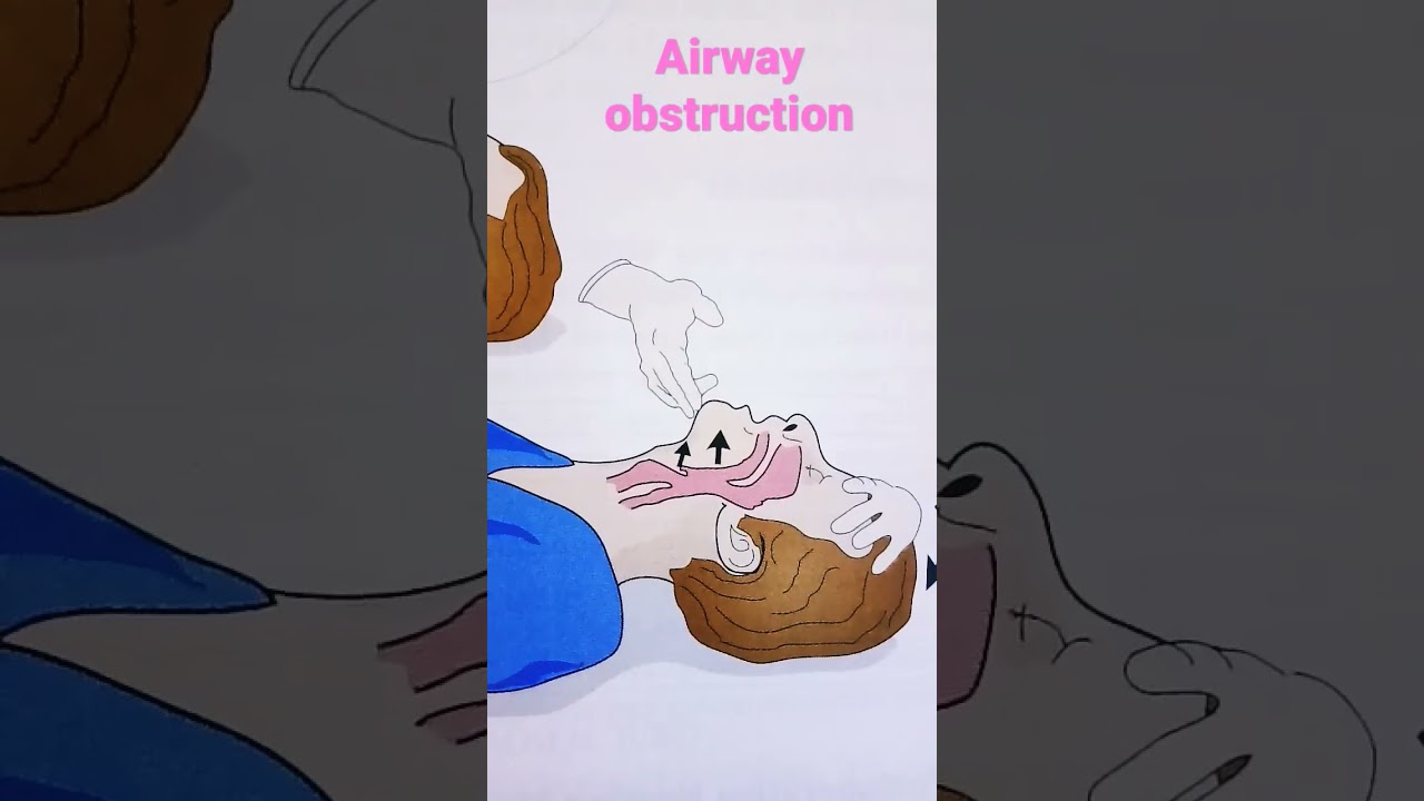 clearing an upper Airway obstruction