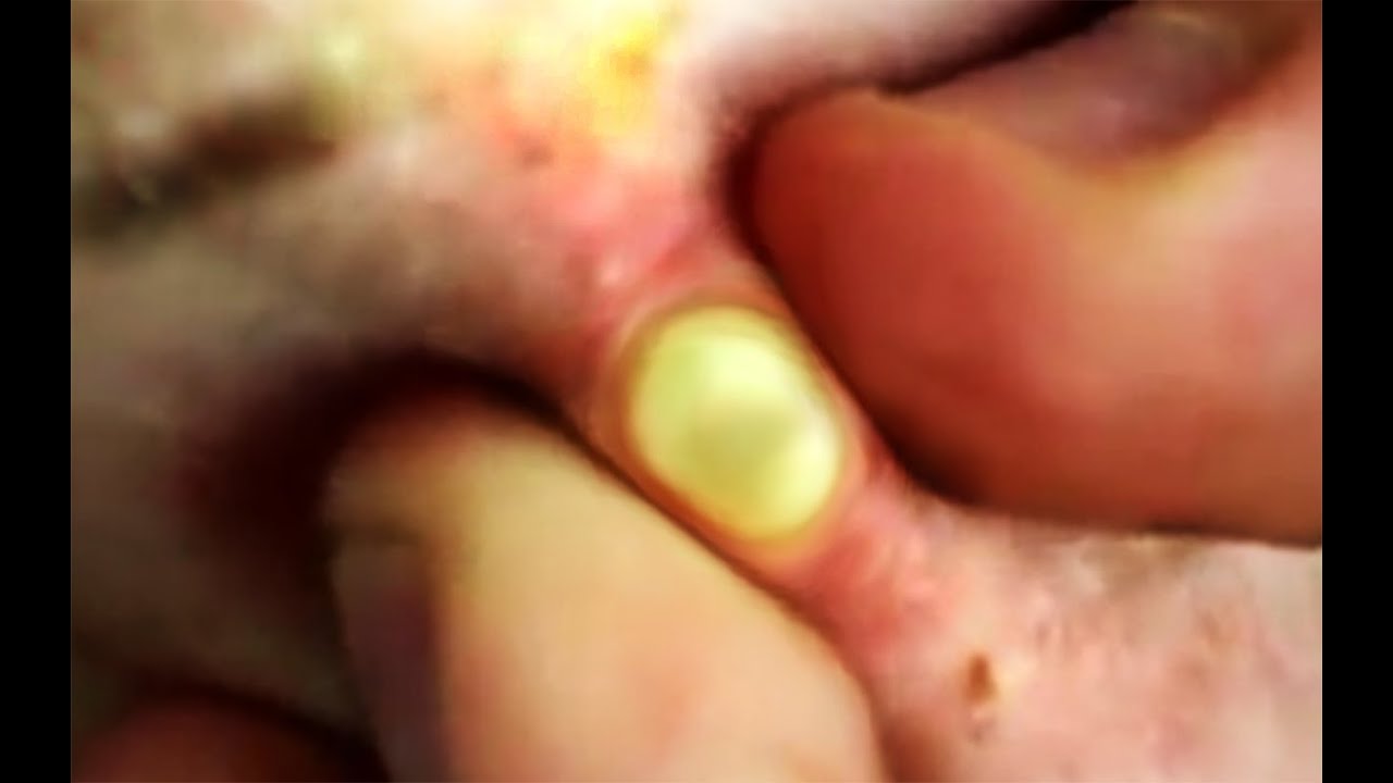 Slideshow: Boils and the Skin - WebMD