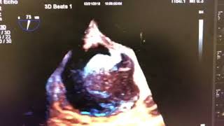 2D3D-Tee Of A Huge Ra Thrombus Attached To The Atrial Septum