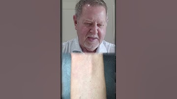 Getting Bitten by a Leafhopper Assassin Bug—Not a Good Idea!