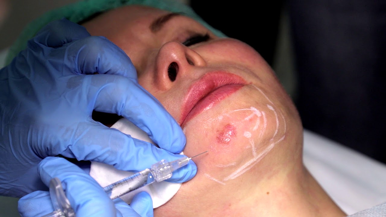 Коррекция подбородка